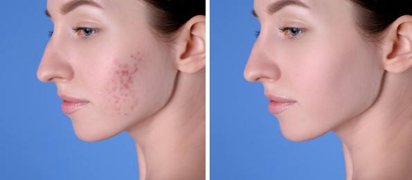 Acne problem. Young woman before and after treatment on blue background, collage of photos