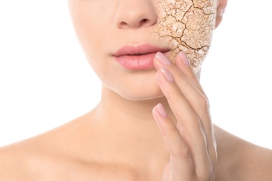 Image of Beautiful young woman with dry skin on white background, closeup