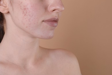 Photo of Young woman with acne problem on beige background, closeup. Space for text