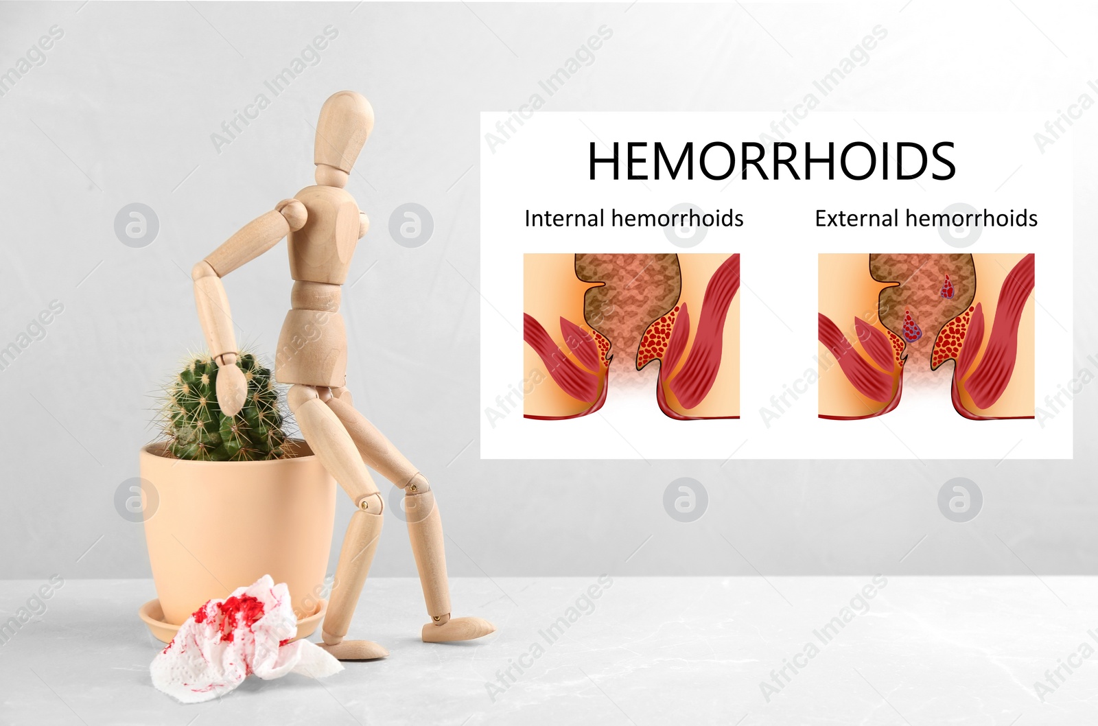 Image of Hemorrhoids. Wooden human figure near cactus and illustrations of unhealthy lower rectum
