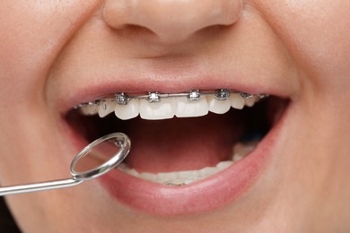 Examination of woman's teeth with braces using mirror tool, closeup