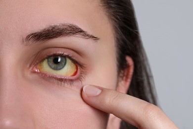 Woman with yellow eyes on light background, closeup. Symptom of hepatitis