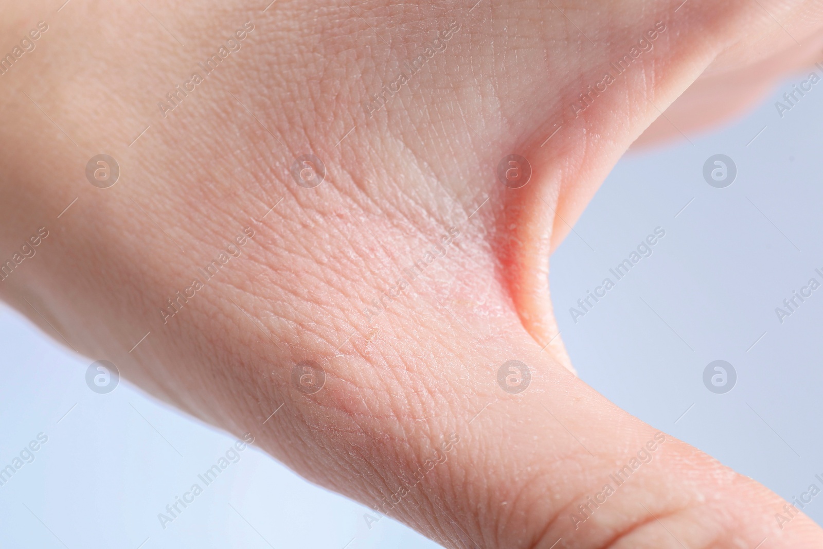 Photo of Woman with dry skin on hand against light background, closeup