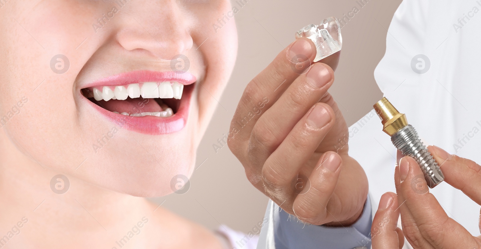Image of Young woman with beautiful smile and dentist holding educational model of dental implant on light background, closeup. Banner design