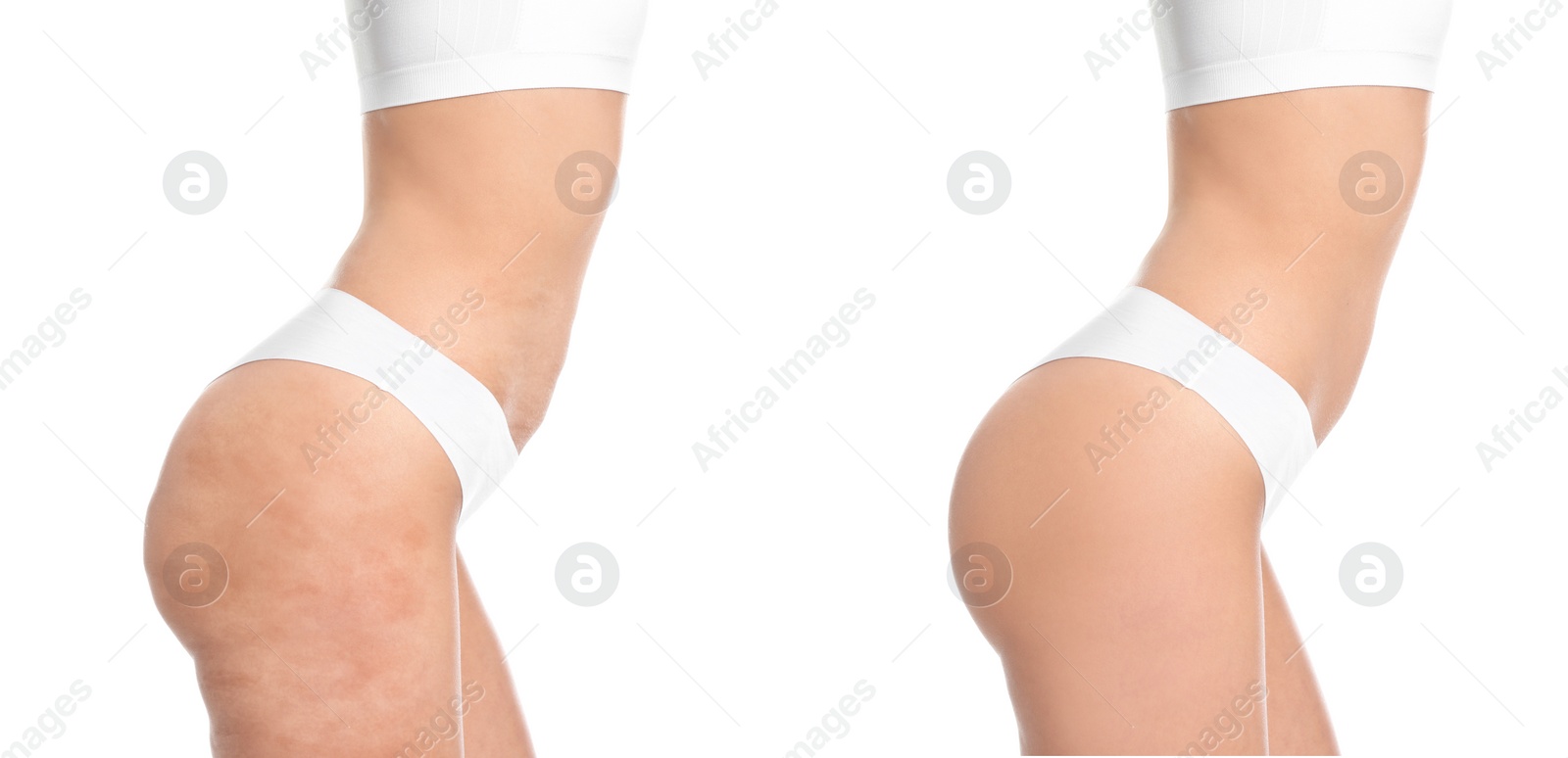 Image of Young woman before and after beauty procedure on white background, closeup. Banner design