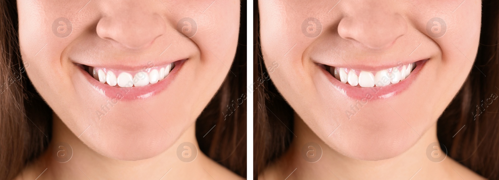 Image of Young woman before and after gingivoplasty procedure, closeup. Banner design