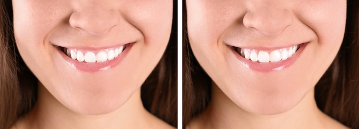 Young woman before and after gingivoplasty procedure, closeup. Banner design