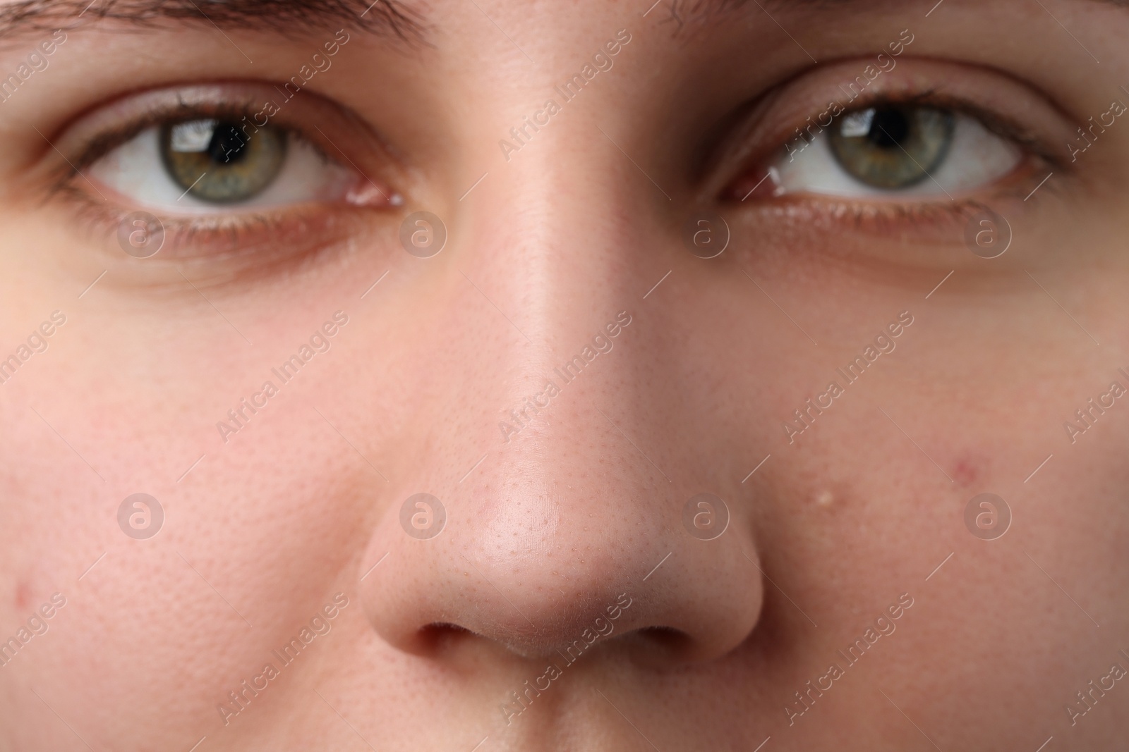 Photo of Young woman with acne problem, closeup view