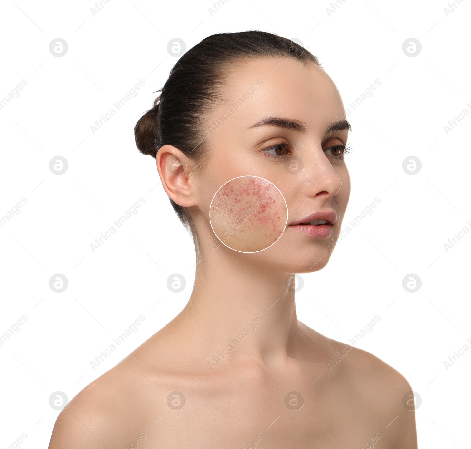 Image of Woman before and after cosmetology procedure on white background. Zoomed area showing problem skin