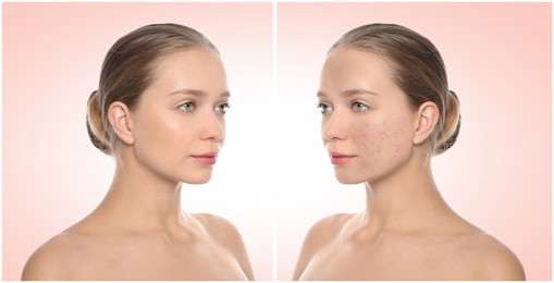 Young woman with acne problem before and after treatment on light background, collage. Banner design