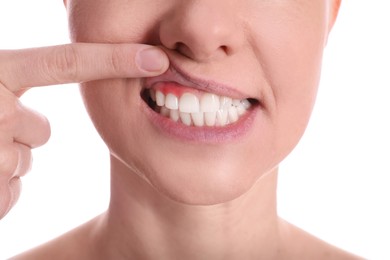 Photo of Woman showing inflamed gums on white background, closeup view