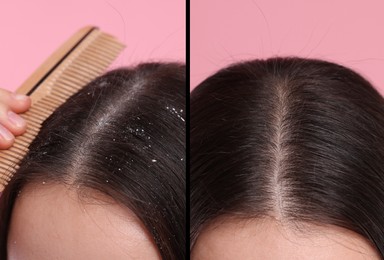 Woman showing hair before and after dandruff treatment on pink background, collage