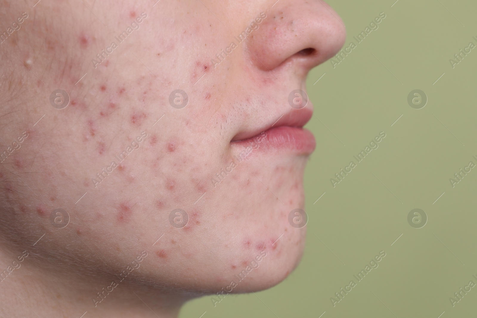 Photo of Young man with acne problem on olive background, closeup