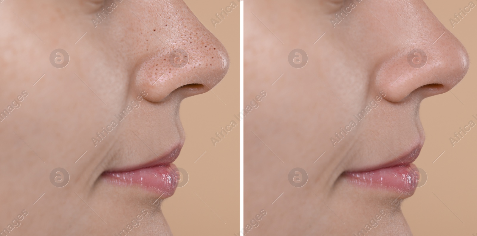 Image of Blackhead treatment, before and after. Collage with photos of woman on beige background, closeup view