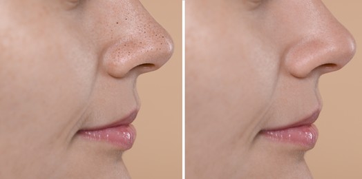 Blackhead treatment, before and after. Collage with photos of woman on beige background, closeup view