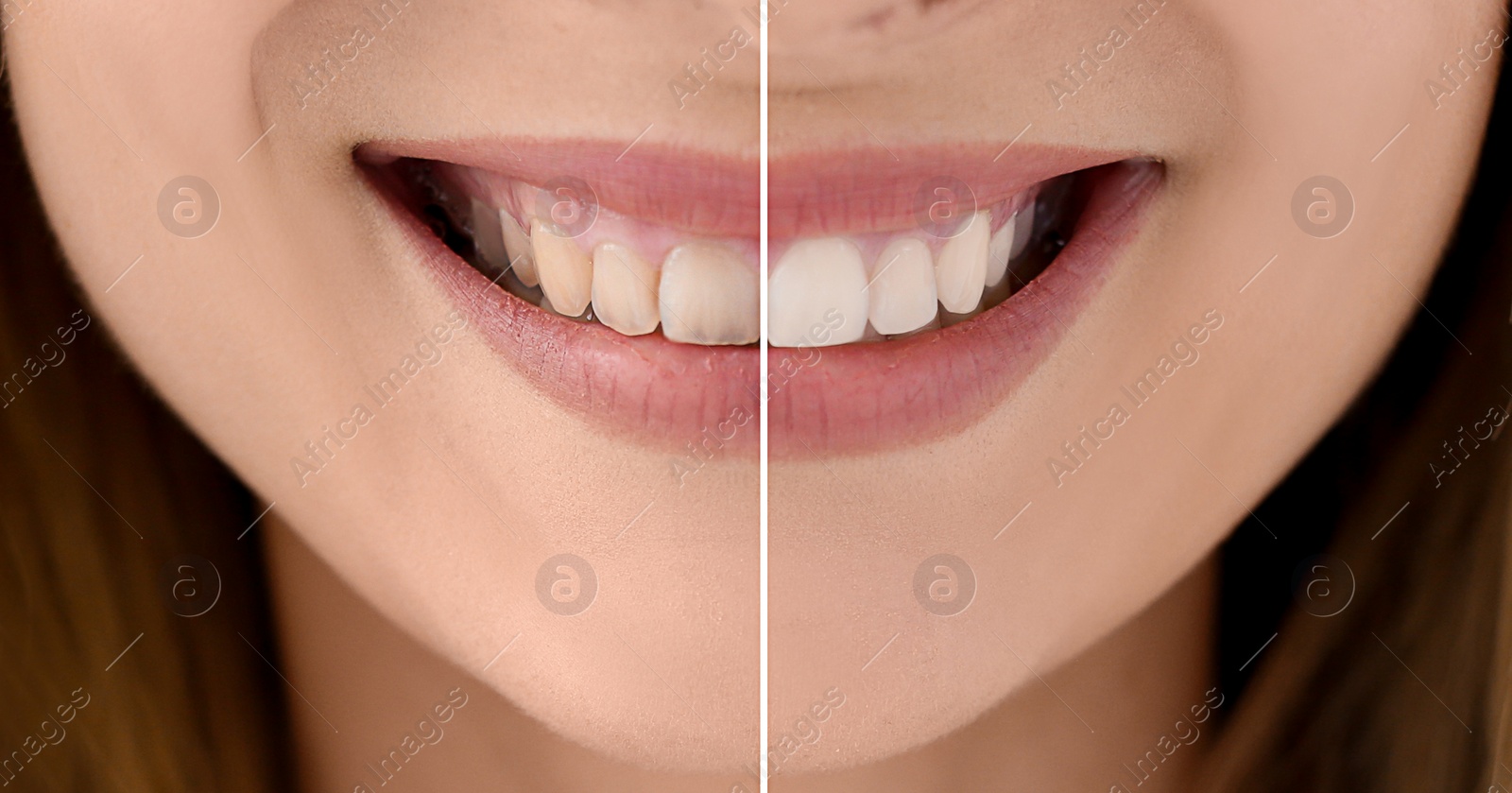 Image of Collage with photos of woman before and after teeth whitening, closeup. Banner design