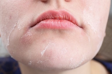 Photo of Woman with dry skin on face, closeup