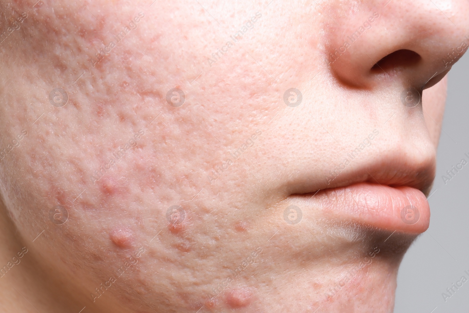 Photo of Young woman with acne on her face, closeup