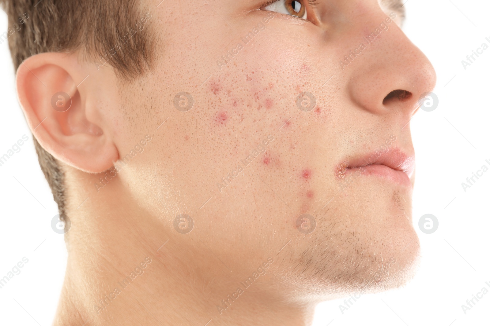 Photo of Young man with acne problem on white background