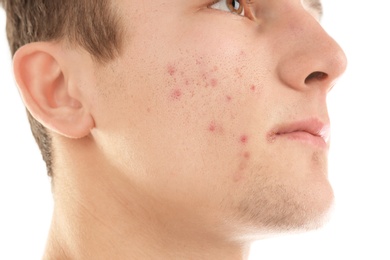 Young man with acne problem on white background