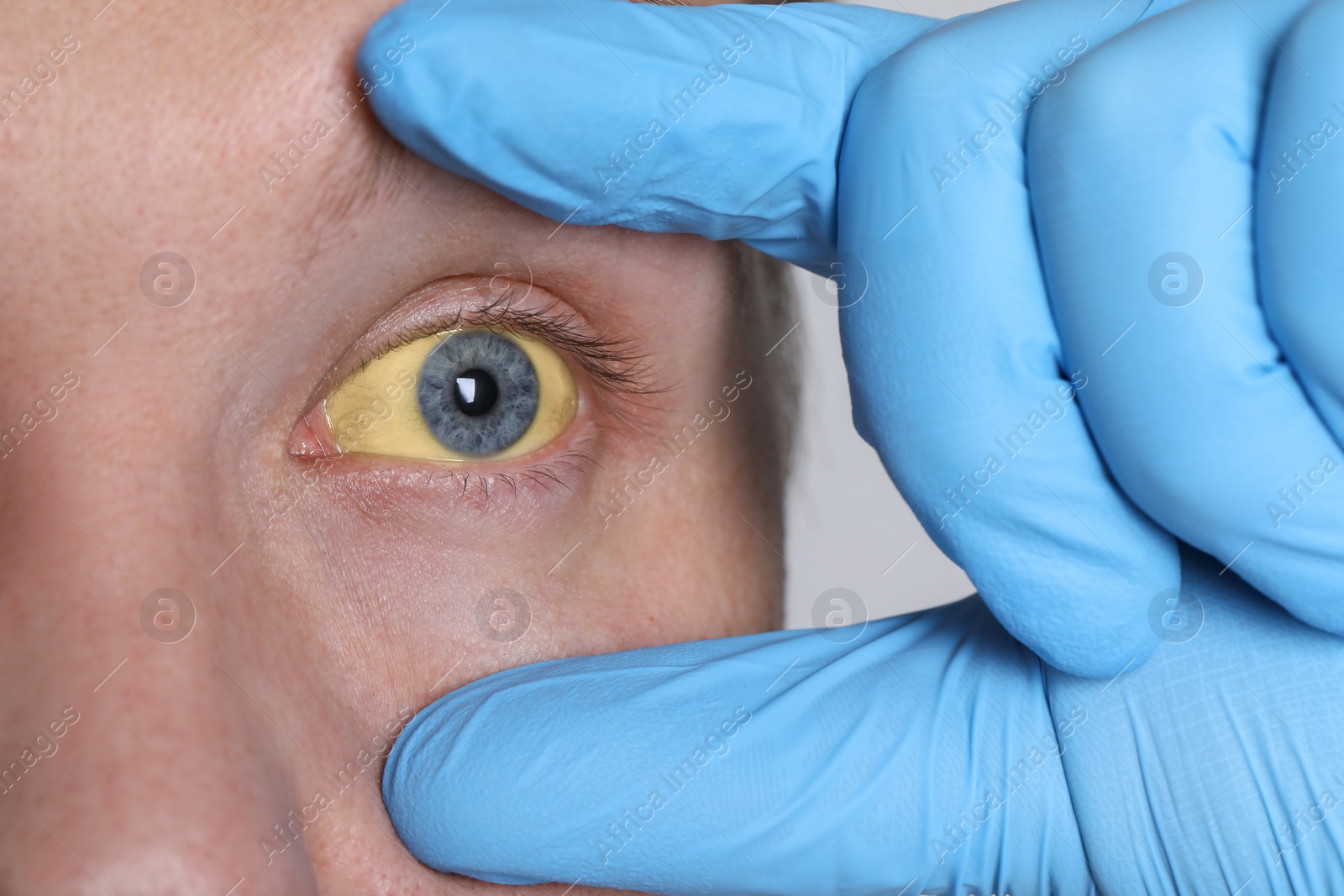 Photo of Doctor checking man with yellow eyes on light background, closeup. Symptom of hepatitis