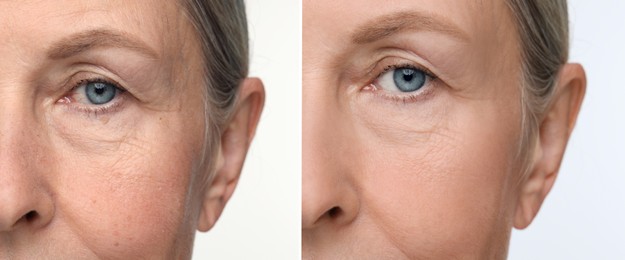 Image of Aging skin changes. Collage with photos of mature woman before and after cosmetic procedure on white background, closeup