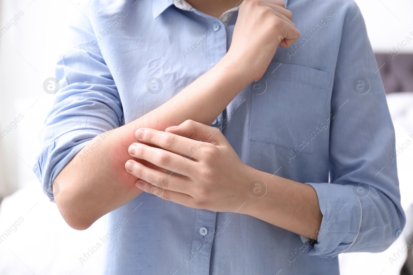 Photo of Young woman scratching hand indoors, closeup. Allergies symptoms