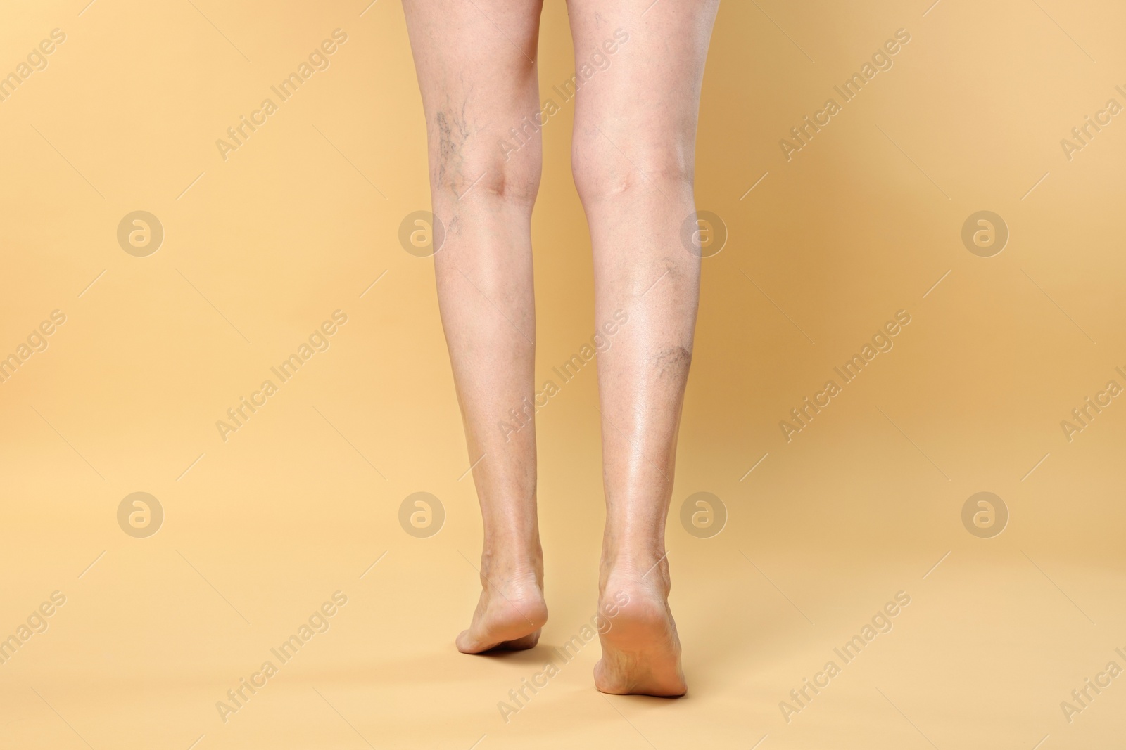 Photo of Closeup view of woman with varicose veins on yellow background