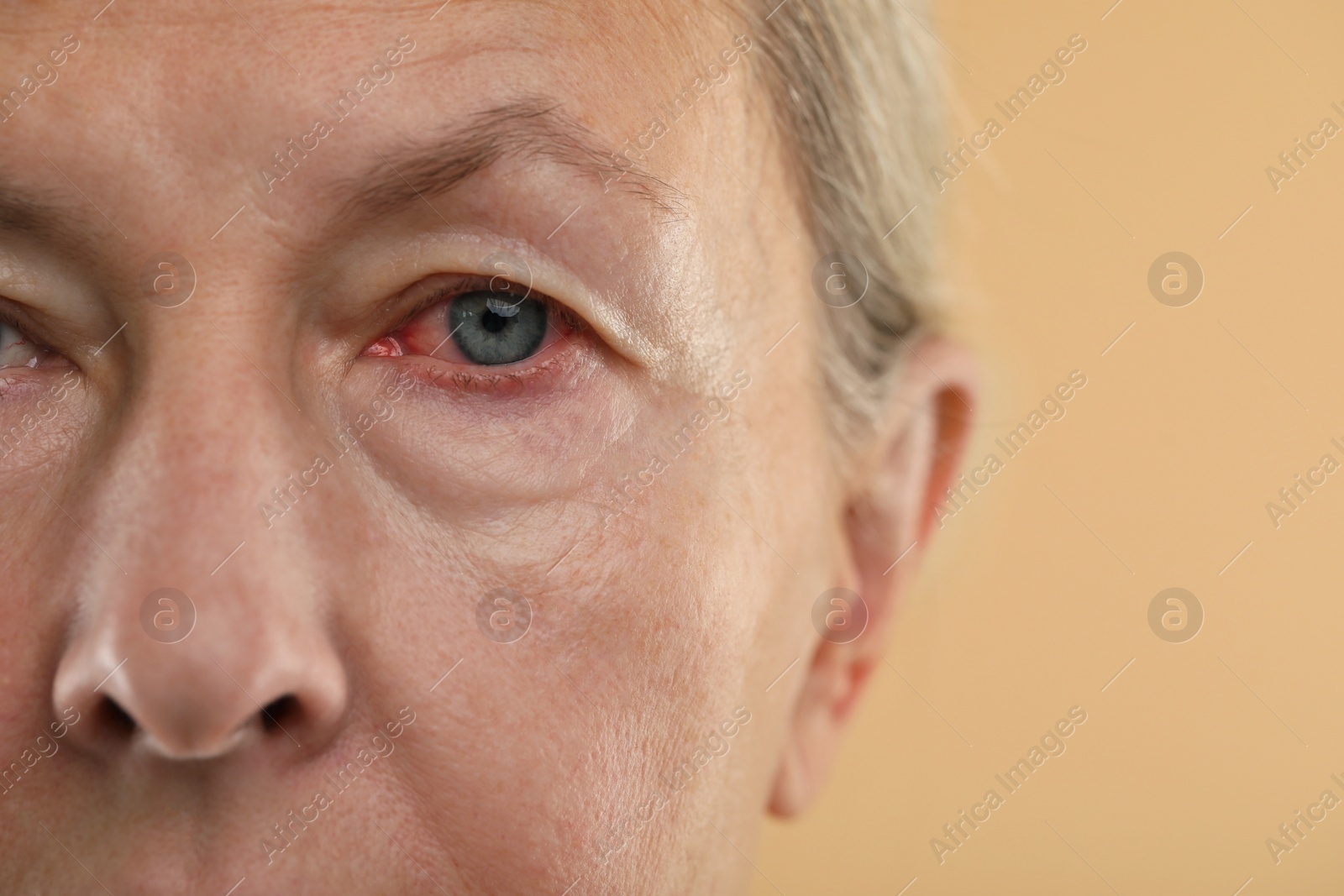 Image of Woman with red eye suffering from conjunctivitis on beige background, closeup