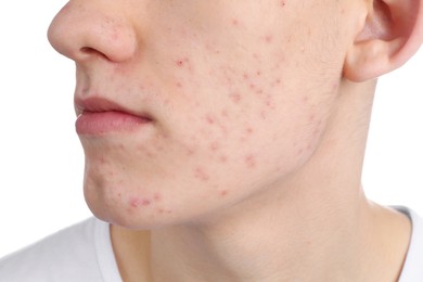 Young man with acne problem isolated on white, closeup