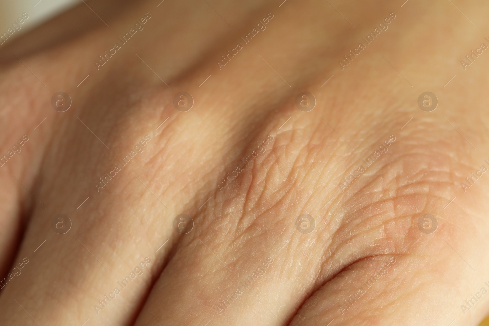 Photo of Closeup view of person with dry skin on hand