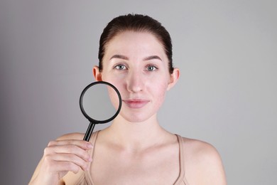 Young woman with acne problem holding magnifying glass near her skin on light grey background