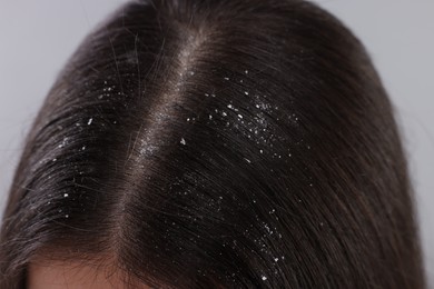 Photo of Woman with dandruff problem on grey background, closeup