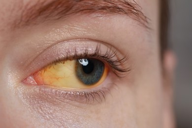 Photo of Woman with yellow eyes on blurred background, closeup. Symptom of hepatitis