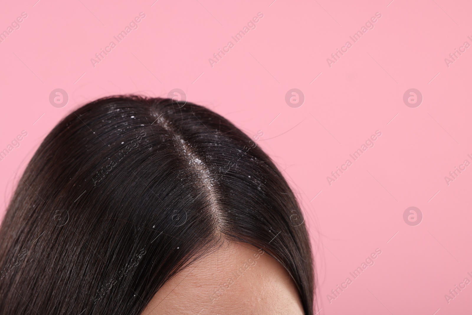 Photo of Woman with dandruff in her dark hair on pink background, closeup. Space for text