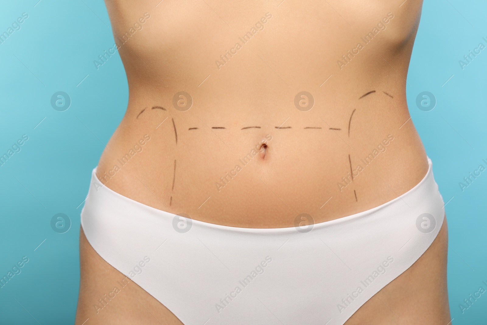Photo of Slim woman with markings on belly before cosmetic surgery operation on light blue background, closeup