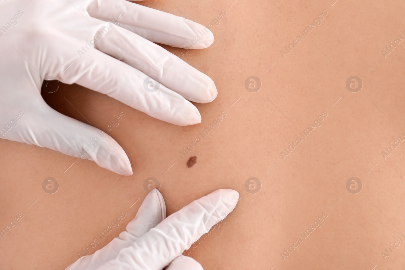 Photo of Dermatologist examining patient in clinic, closeup view