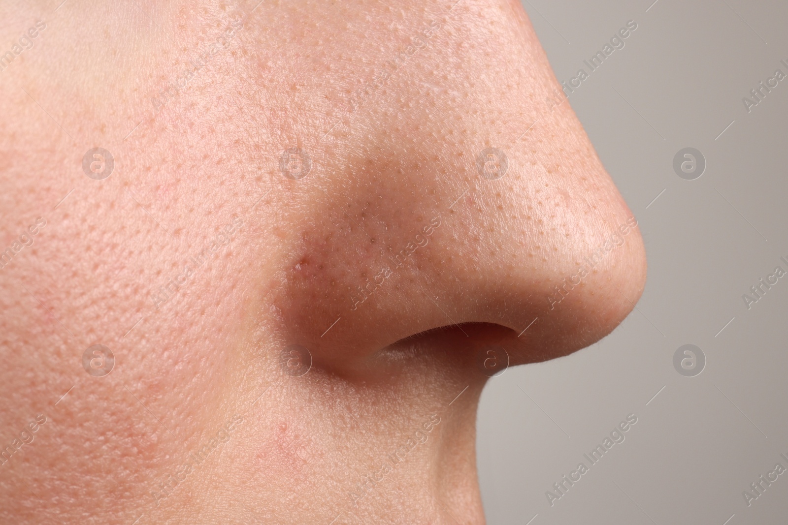 Photo of Young woman with acne problem on grey background, closeup view of nose