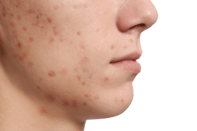 Teen guy with acne problem on white background, closeup