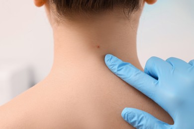 Dermatologist examining patient's birthmark on blurred background, closeup