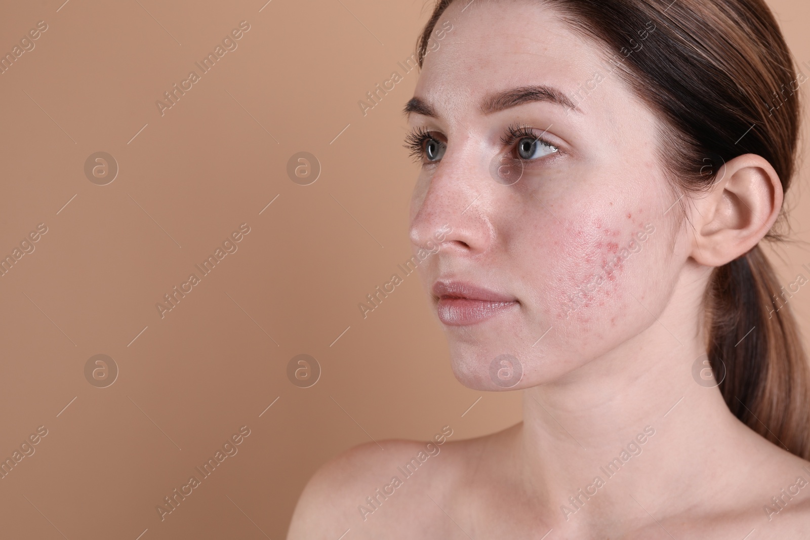 Photo of Young woman with acne problem on beige background. Space for text