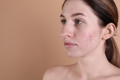 Young woman with acne problem on beige background. Space for text