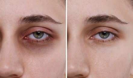 Image of Collage with photos of woman with dark circle under eye before and after treatment, closeup