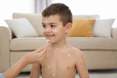 Photo of Woman applying cream onto skin of little boy with chickenpox at home