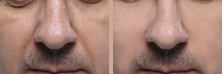 Aging skin changes. Man showing face before and after rejuvenation, closeup. Collage comparing skin condition