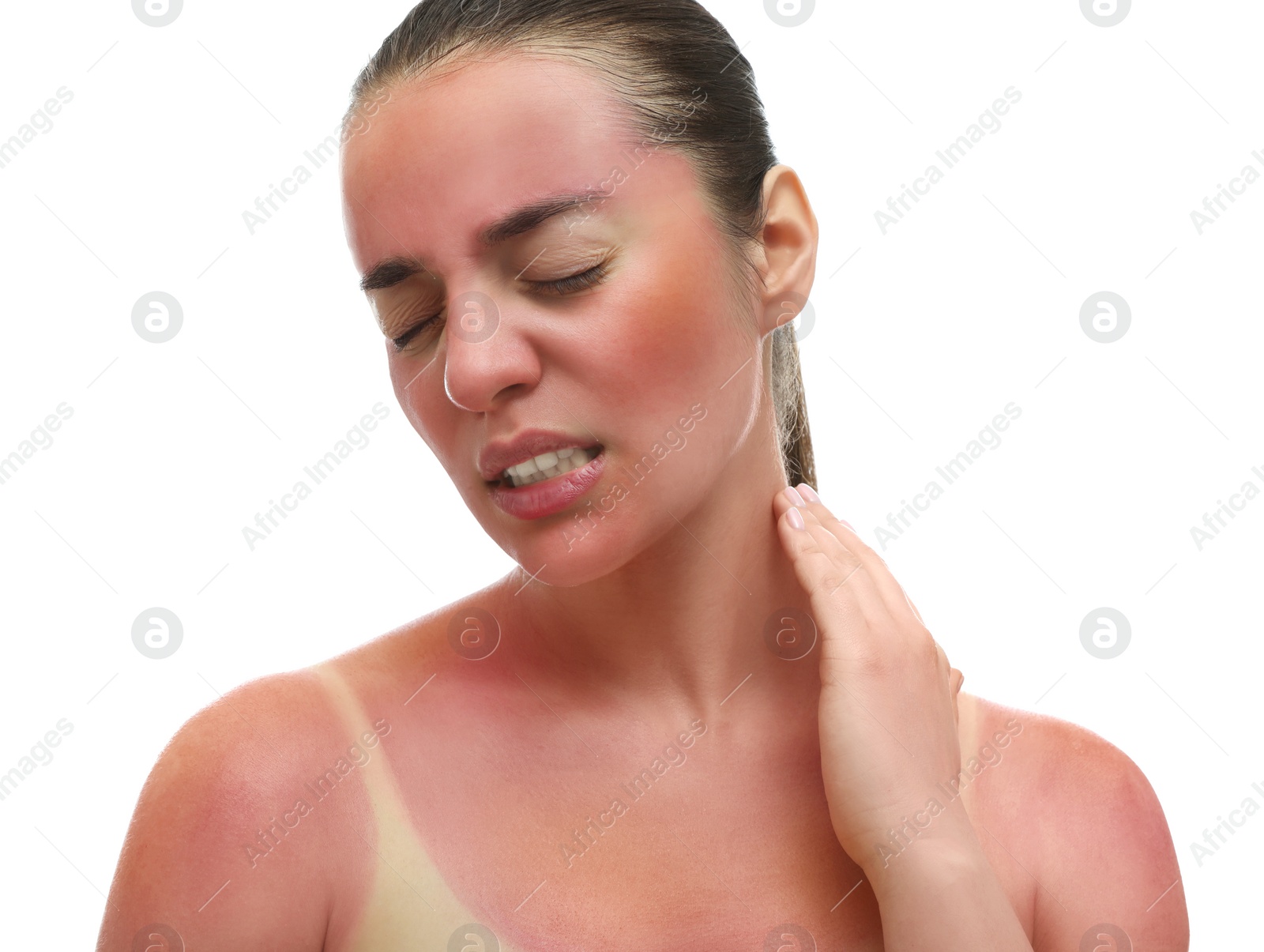 Photo of Woman with sunburned skin on white background