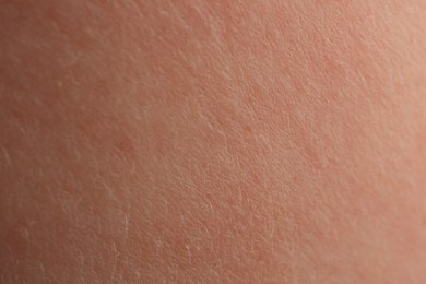 Photo of Texture of dry skin as background, macro view