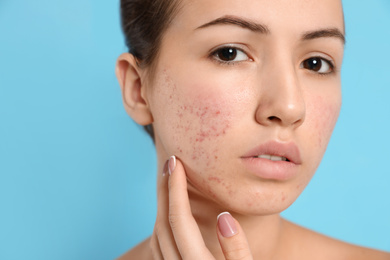 Photo of Teen girl with acne problem on light blue background