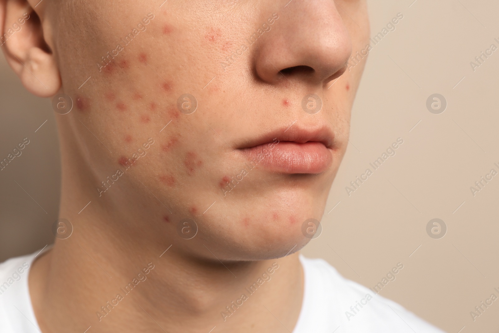 Photo of Teen guy with acne problem on beige background, closeup