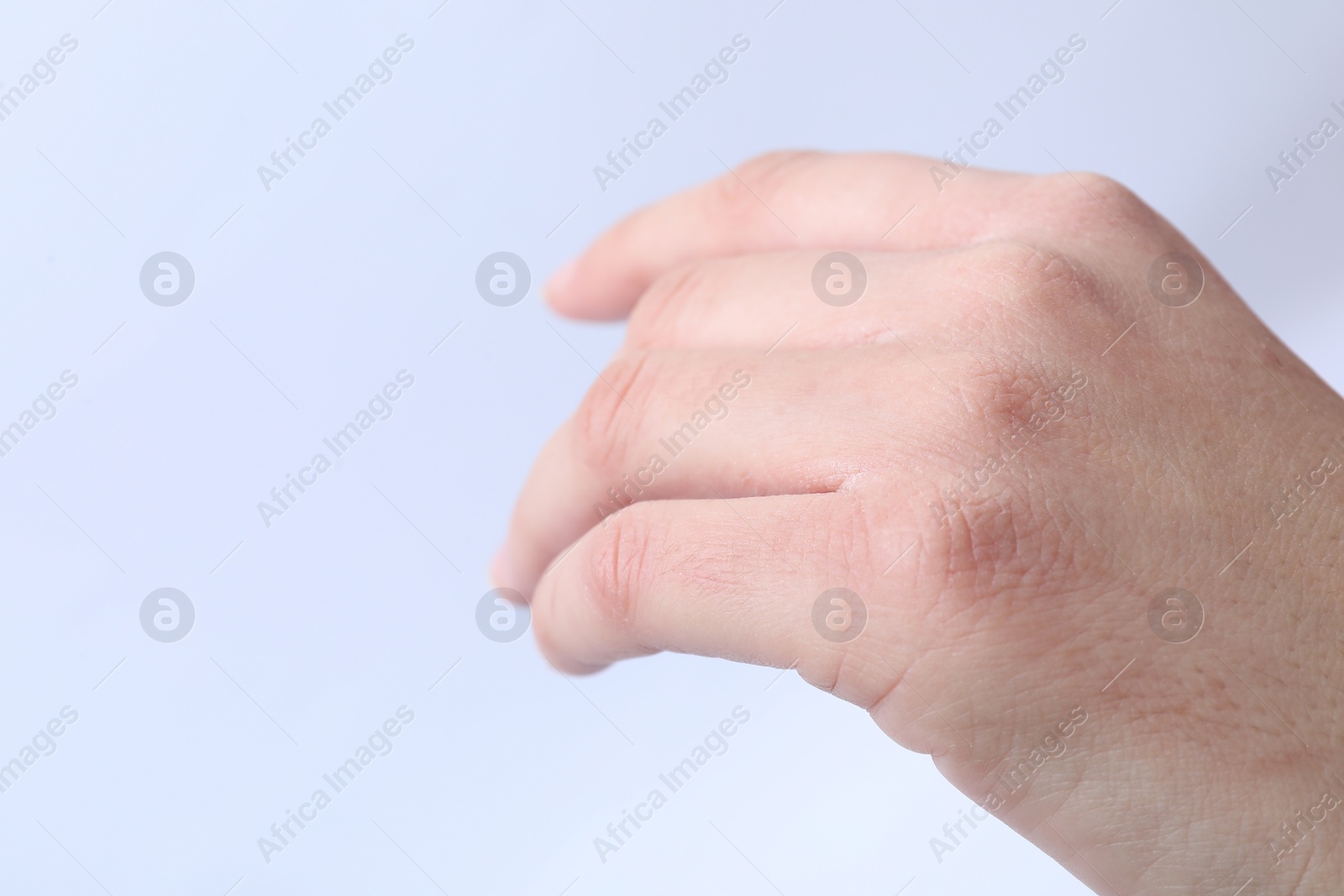 Photo of Woman with dry skin on hand against light background, closeup. Space for text